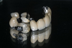 Răng sứ kim loại thường